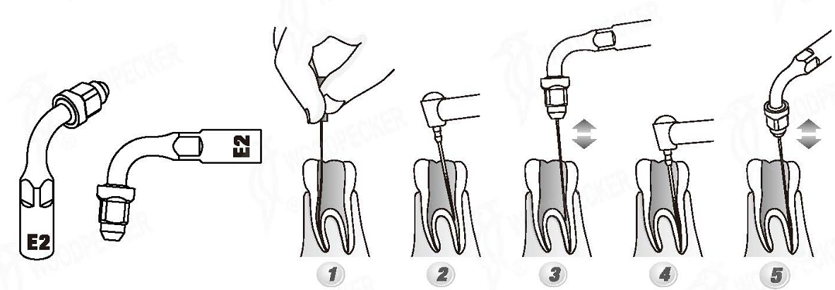Woodpecker®UDSシリーズ根管治療用チップE2（EMSと交換、5本入）