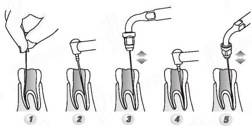 Woodpecker®DTE根管治療用チップED2（SATELECと交換、5本入）