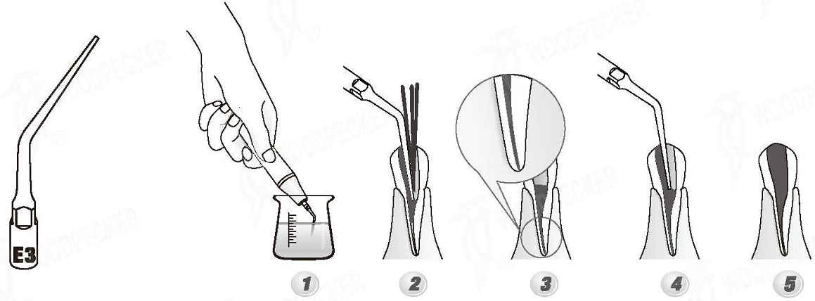 Woodpecker®UDSシリーズ根管治療用チップE3（EMSと交換、5本入）