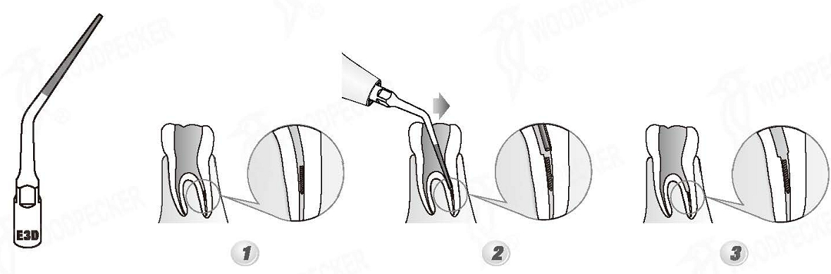 Woodpecker®UDSシリーズ根管治療用チップE3D（EMSと交換、5本入）