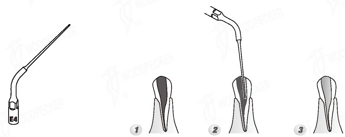 Woodpecker®UDSシリーズ根管治療用チップE4（EMSと交換、5本入）