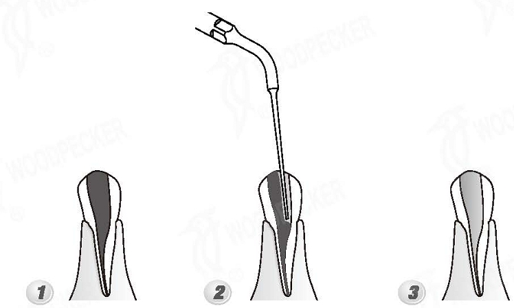 Woodpecker®DTE根管治療用チップED4（SATELECと交換、5本入）