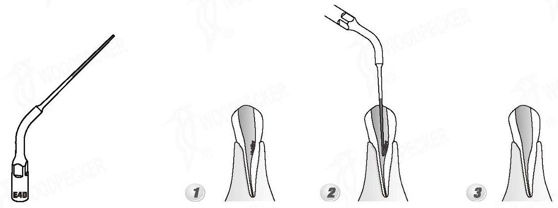 Woodpecker®UDSシリーズ根管治療用チップE4D（EMSと交換、5本入）