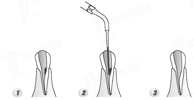 Woodpecker®DTE根管治療用チップED4D（SATELECと交換、5本入）