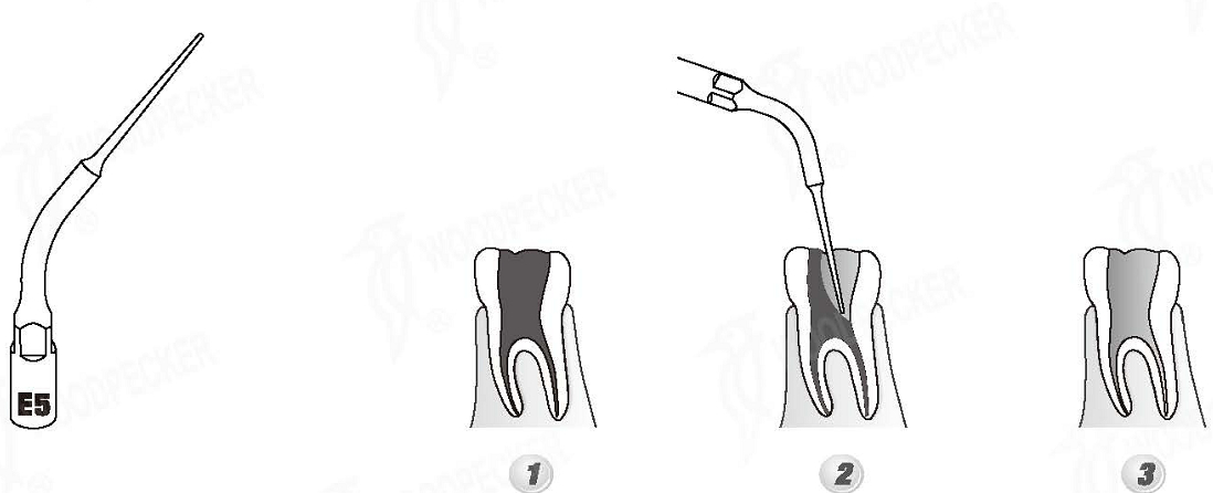 Woodpecker®UDSシリーズ根管治療用チップE5（EMSと交換、5本入）