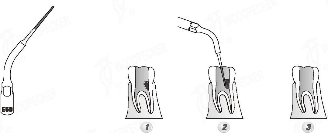 Woodpecker®UDSシリーズ根管治療用チップE5D（EMSと交換、5本入）