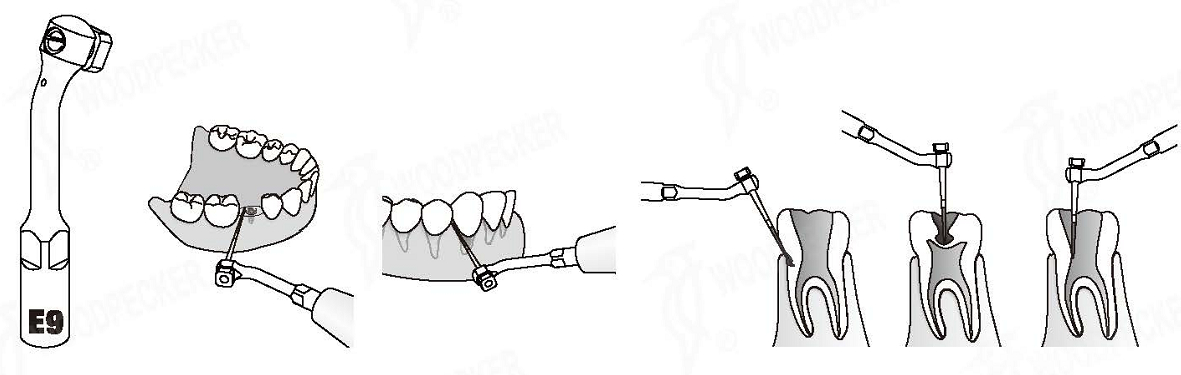 Woodpecker®UDSシリーズ根管治療用チップE9（EMSと交換、5本入）