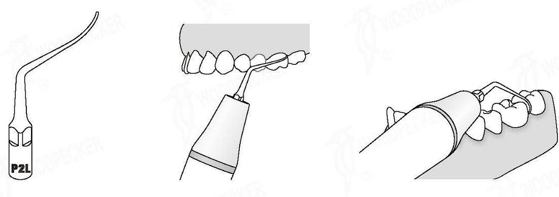 Woodpecker®UDSペリオ用スケーラーチップP2L（EMSと交換 5本入）