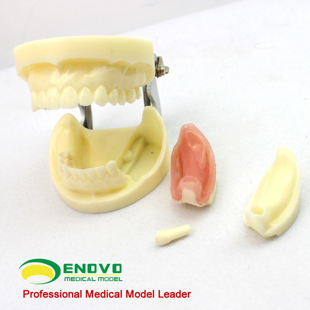 ENOVO®歯科口腔外科インプラント実習用模型-歯科インプラント説明模型
